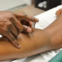 The insertion of acupuncture needles is usually painless or causes minimal discomfort. You may...
