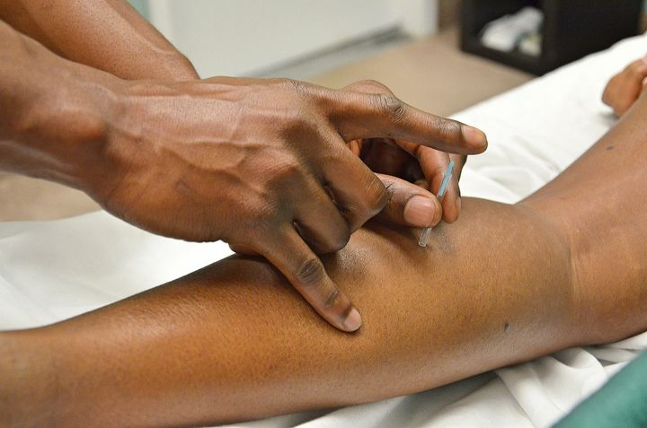 The insertion of acupuncture needles is usually painless or causes minimal discomfort. You may...