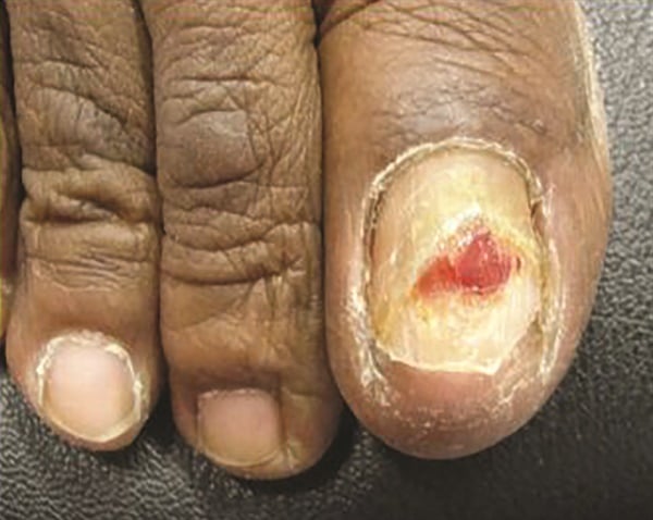Chemotherapy-induced pyogenic granuloma of the nail bed