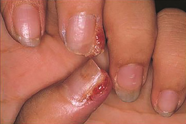 Chemotherapy-induced periungual pyogenic granuloma
