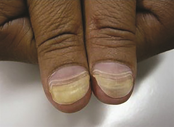 Chemotherapy-induced onycholysis