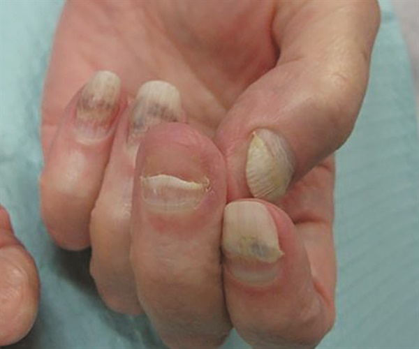 Chemotherapy-induced hemorrhagic onycholysis
