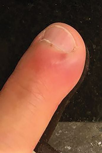 Acute paronychias are red, swollen, and tender to the touch.