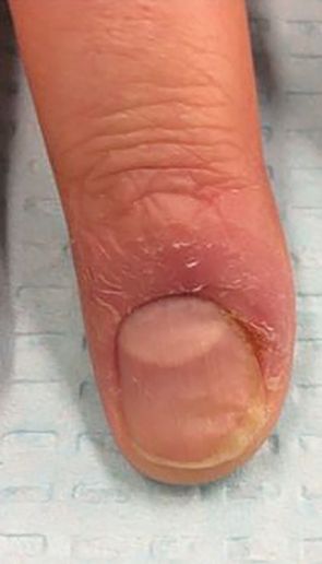 With chronic paronychias, the cuticle is compromised or completely absent.