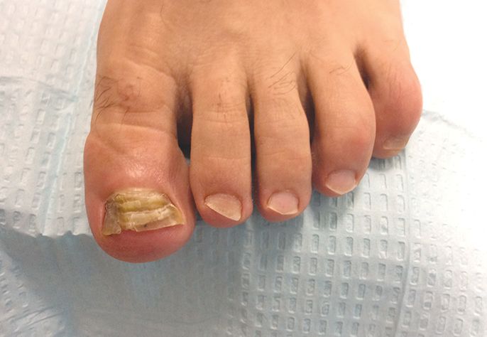 Only 50% of abnormal, thick, discolored toenails are due to fungus. That’s why an accurate...