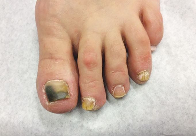 Although the appearance of nail fungus can vary greatly, generally the nail appears yellow,...