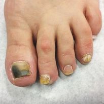 A Day in the Life of a Nail Expert: Diagnosing and Treating Nail Fungus