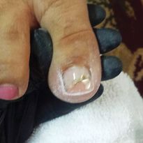 Correcting Toenail Issues — From Stubbed Toes to Total Reconstruction