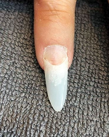 How to Correct Ski Jump Nails