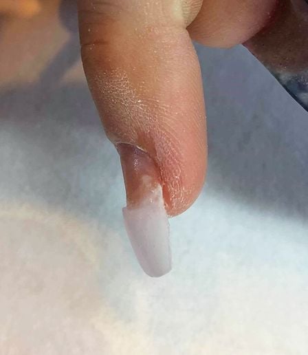 How to Correct Ski Jump Nails