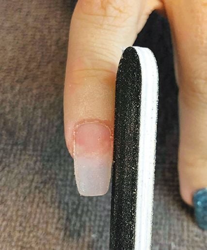 How to Correct Ski Jump Nails