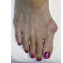 What Are Neuromas?