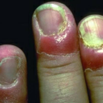 What Is Paronychia?