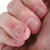 Although the exact cause of onychophagia is unknown, there are studies that show a possible...