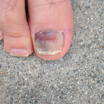 This injury occurred when the toe was repeatedly forced into the tip of a hiking boot while...