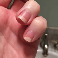 Something to Talk About: Onycholysis